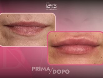 Filler labbra prima e dopo - 874824