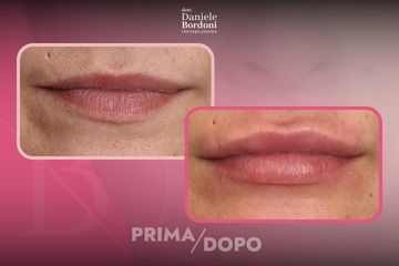 Dott. Daniele Bordoni Filler Labbra