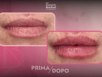 Filler labbra prima e dopo - 874825
