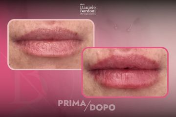 Dott. Daniele Bordoni Filler Labbra