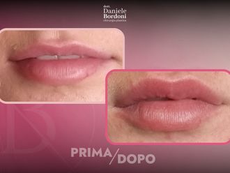 Filler labbra prima e dopo - 874826