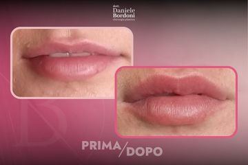 Dott. Daniele Bordoni Filler Labbra