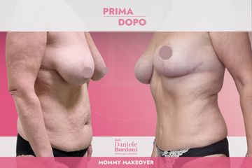 Dott. Daniele Bordoni Mommy Makeover