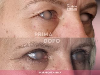 Blefaroplastica prima e dopo - 874837