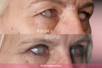 Dott. Daniele Bordoni Blefaroplastica