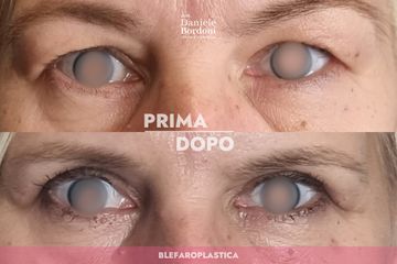 Dott. Daniele Bordoni Blefaroplastica