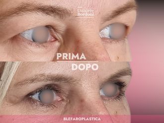 Blefaroplastica prima e dopo - 874839