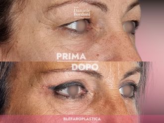 Blefaroplastica prima e dopo - 874840