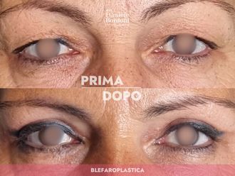 Blefaroplastica prima e dopo - 874841