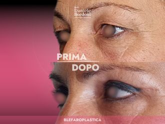 Blefaroplastica prima e dopo - 874842