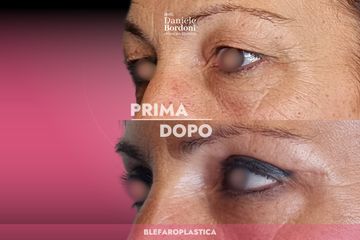 Dott. Daniele Bordoni Blefaroplastica
