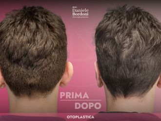 Otoplastica prima e dopo - 874844
