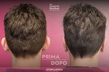 Dott. Daniele Bordoni Otoplastica