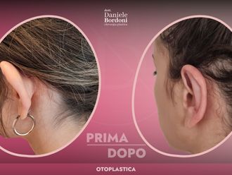 Otoplastica prima e dopo - 874845