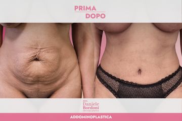 Dott. Daniele Bordoni Addominoplastica