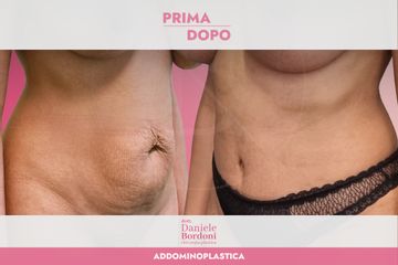 Dott. Daniele Bordoni Addominoplastica