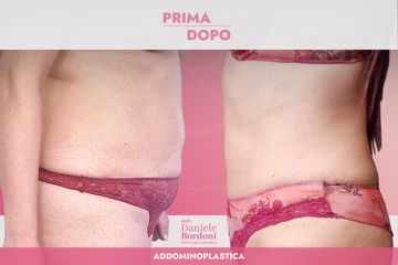 Dott. Daniele Bordoni Addominoplastica