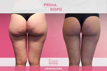 Dott. Daniele Bordoni Liposcultura