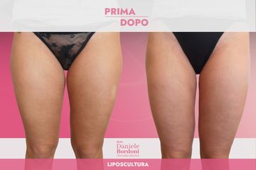 Dott. Daniele Bordoni Liposcultura