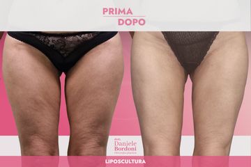 Dott. Daniele Bordoni Liposcultura