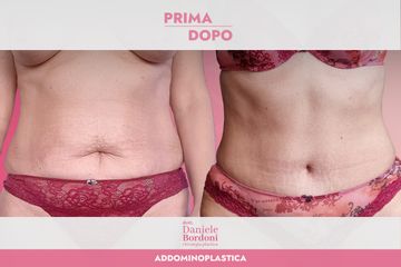 Dott. Daniele Bordoni Addominoplastica