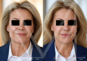 Dott. Emanuele Del Favero Filler labbra con acido ialuronico, prima e dopo