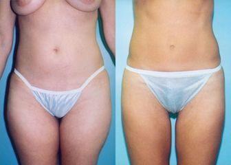 Liposuzione prima e dopo