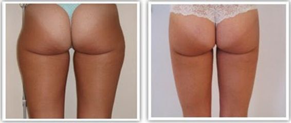 Liposuzione prima e dopo