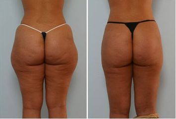 Liposuzione prima e dopo
