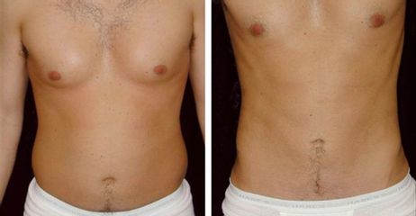 Liposuzione prima e dopo