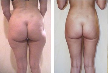 Liposcultura prima e dopo