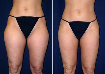 Liposuzione prima e dopo