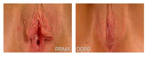 Labioplastica prima e dopo