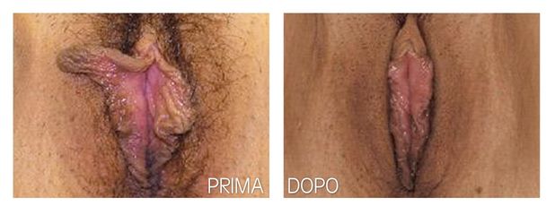 Labioplastica prima e dopo