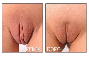 Labioplastica prima e dopo