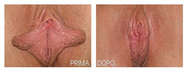 Labioplastica prima e dopo
