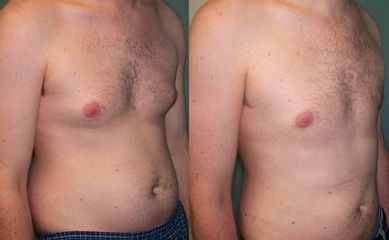 Liposuzione prima e dopo