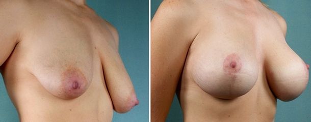 Mastopessi con protesi prima e dopo