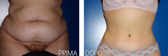 Liposuzione e addominoplastica prima dopo