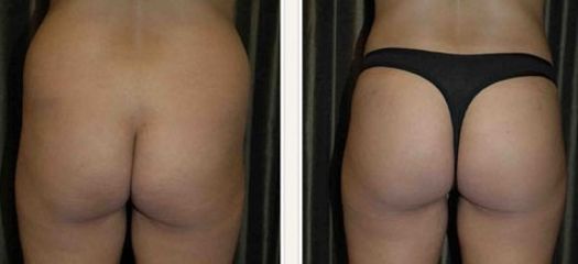 Liposuzione e lipofilling prima dopo