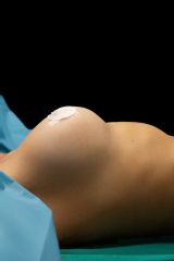 Dott. Stefano Veneroso Mastoplastica Additiva