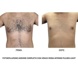 Depilazione Laser - Policologna srl
