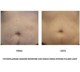 Depilazione Laser - Policologna srl