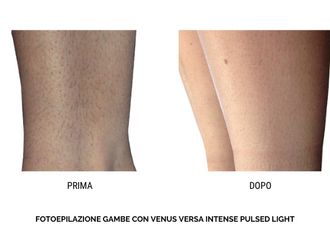 Depilazione laser prima e dopo - 812862
