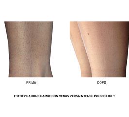 Depilazione laser - Policologna srl