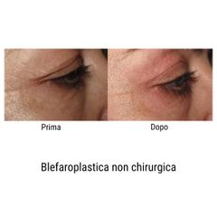 Blefaroplastica non chirurgica - Policologna srl