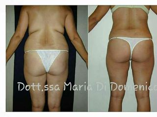 liposcultura prima dopo