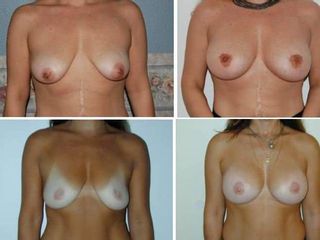 mastopessi prima dopo