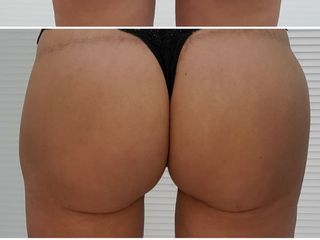 Liposcultura con rimodellamento muscoli retti dell'addome