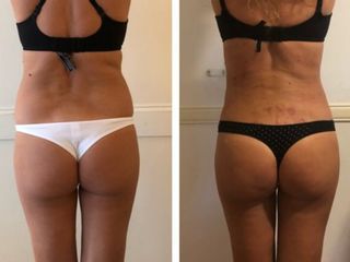 liposcultura prima dopo